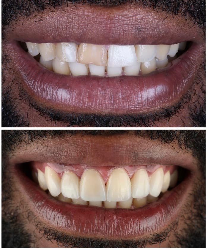 Real patient veneers before and after