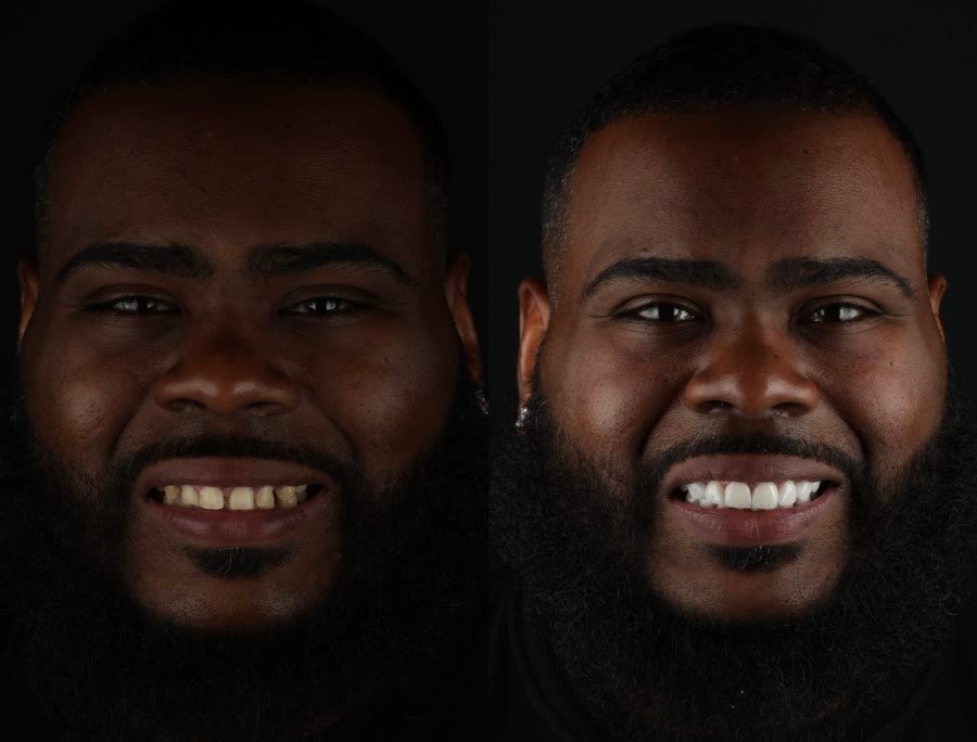 Real patient before and after porcelain veneers