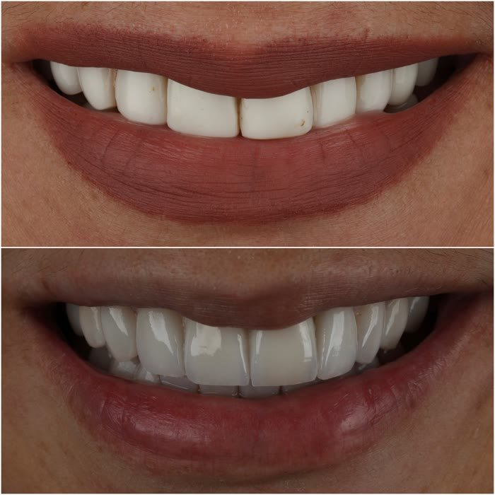 Real patient veneers before and after