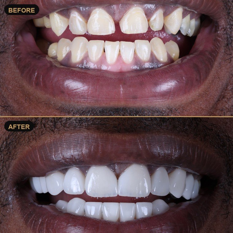 Antes y después de carillas dentales — Dr. Daniel Arredondo Durán