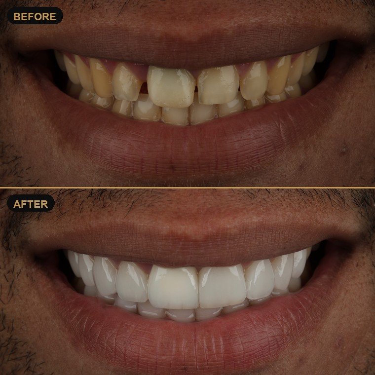 Antes y después de carillas dentales — Dr. Daniel Arredondo Durán