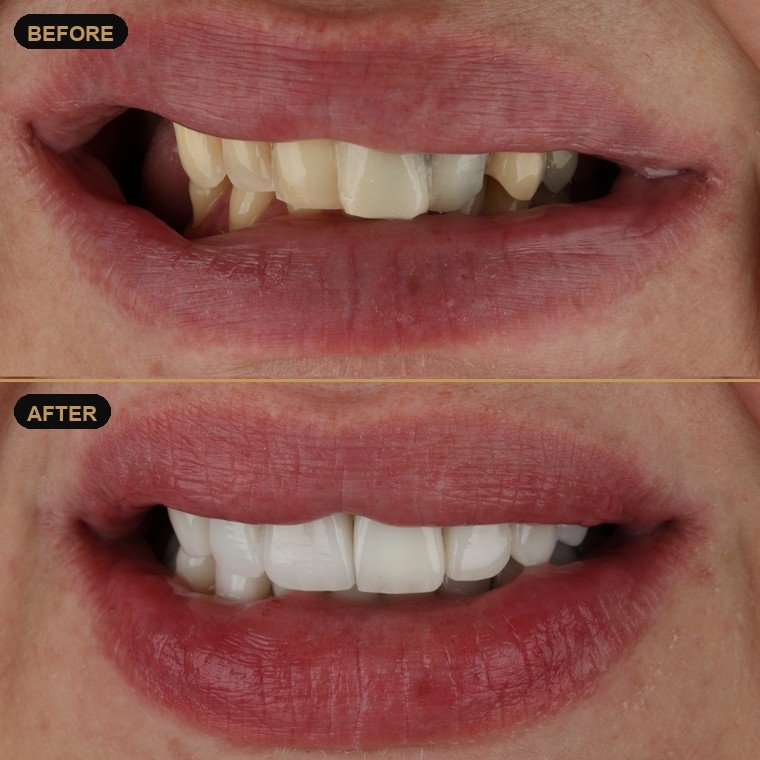 Antes y después de carillas dentales — Dr. Daniel Arredondo Durán