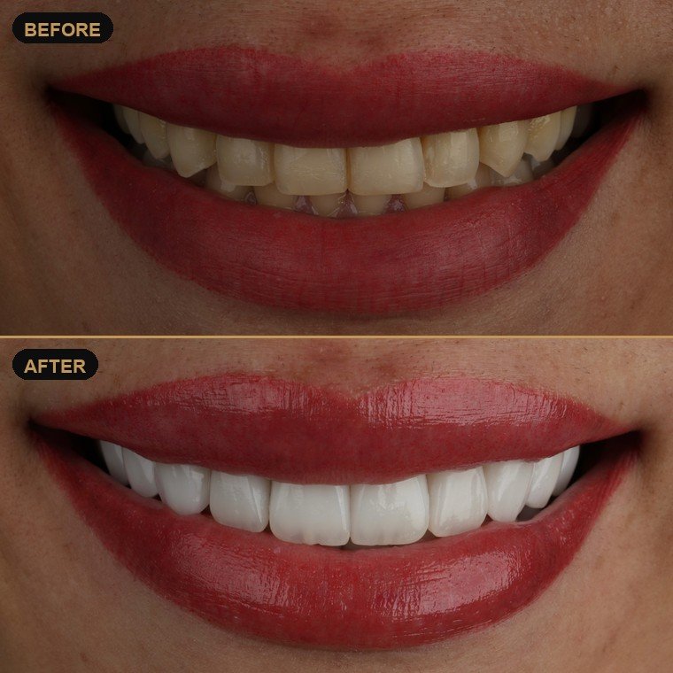 Antes y después de carillas dentales — Dr. Daniel Arredondo Durán