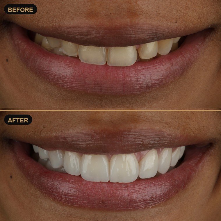 Antes y después de carillas dentales — Dr. Daniel Arredondo Durán