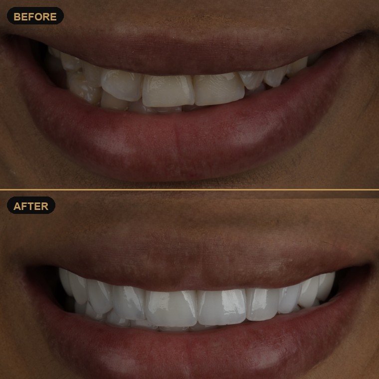 Antes y después de carillas dentales — Dr. Daniel Arredondo Durán